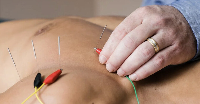 Neurofunctional Acupuncture